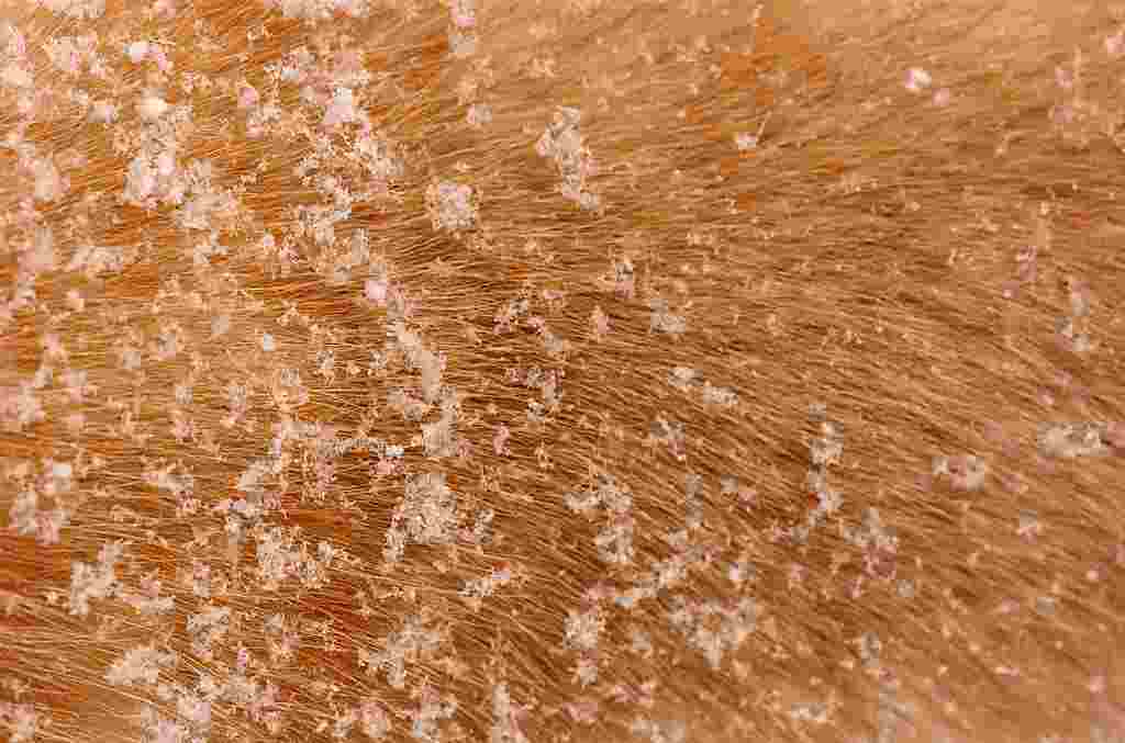What is Dandruff What is Dandruff