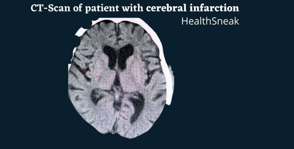 One of the most effective treatments for cerebral infarction involves removing the clot. A catheter is inserted into the femoral artery and directed to the cerebral circulation.