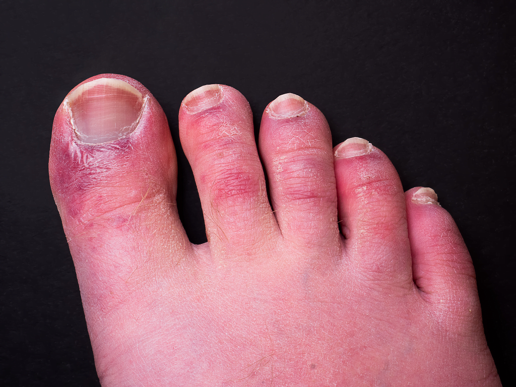Chilblains on fingers and toes can be really uncomfortable and interrupt your daily life, as well as having an effect on the quality of sleep that you get at night. Chilblains on toes can be very painful and unsightly.