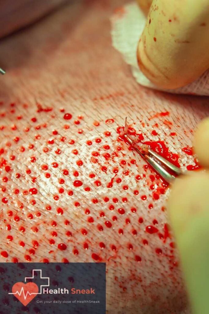 the average hair transplant cost is only $2000 to $4000, and it does not include post-op medications or medications for the anxiety of the procedure.
