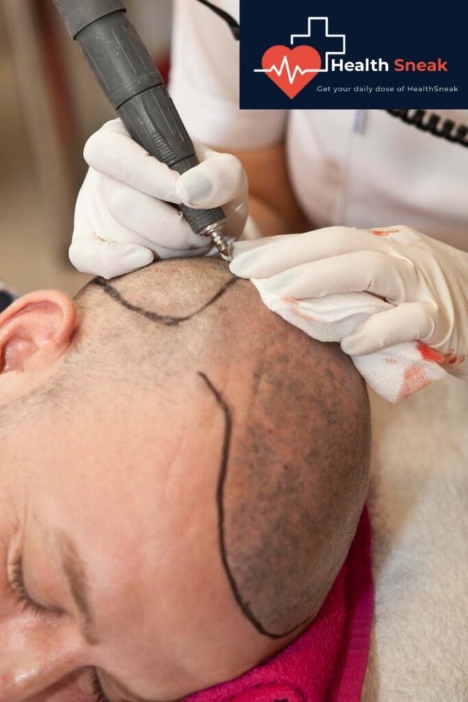 When it comes to hair transplant cost, you need to take care of yourself and your budget. The first thing you need to do is calculate the area of hair loss and the amount of hair needed, and then contact a hair transplant surgeon to request a consultation.