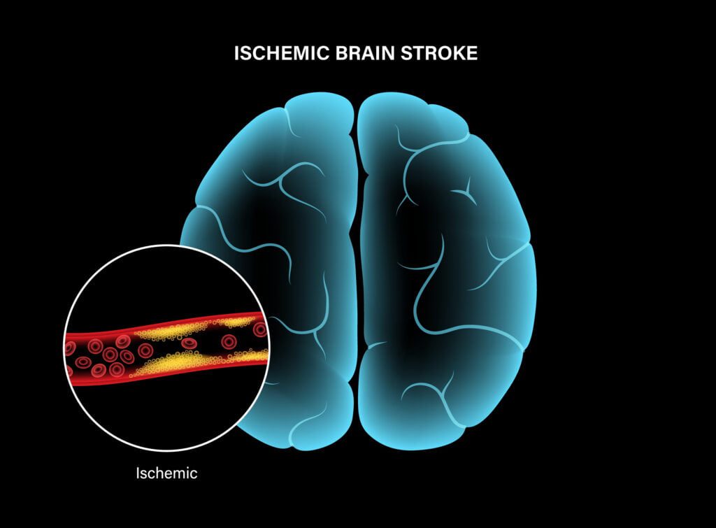 Cerebral infarction is defined as the pathological process that causes the formation of necrotic tissue within the cerebral cortex (cerebral infarct). It results from a deteriorated blood flow (ischemia) and reduced oxygen delivery (hypoxia) typically due to thromboembolism.