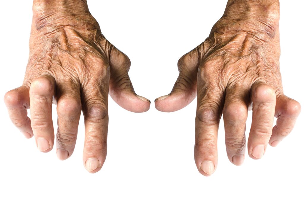 Rheumatoid arthritis is a chronic inflammatory disorder in the body that affects the bones, joints, and surrounding tissues.