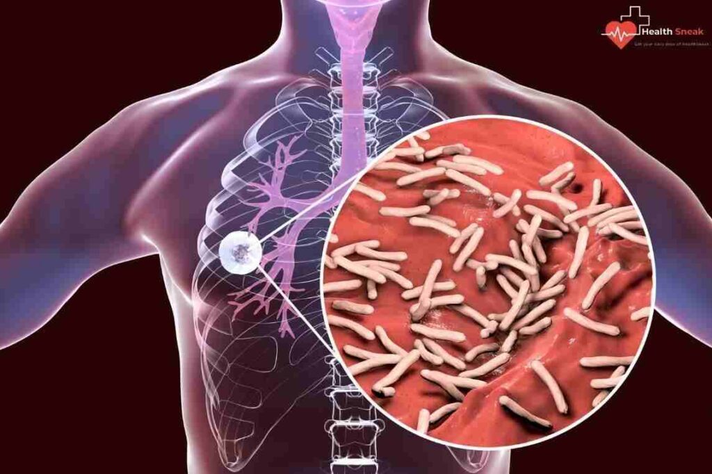 Tuberculosis can prove fatal if it is not treated. While the active disease most commonly affects your lungs, it can also affect other parts of your body.