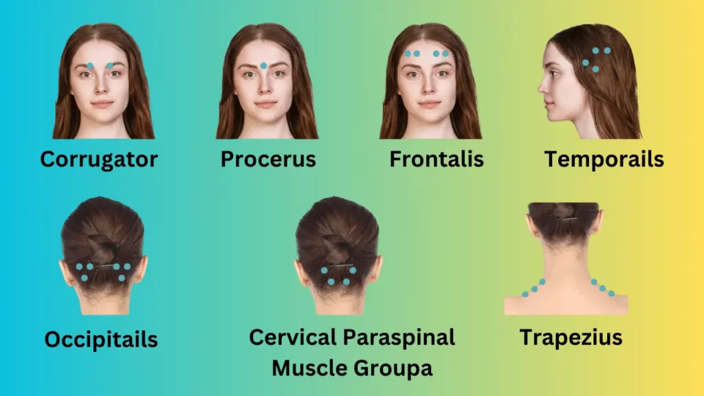 Botox for Migraines Before and After Pictures